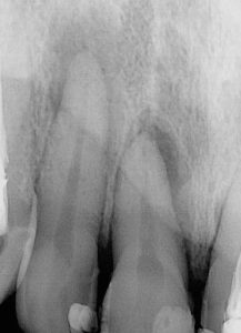 What Happens In Root Canal Treatment?